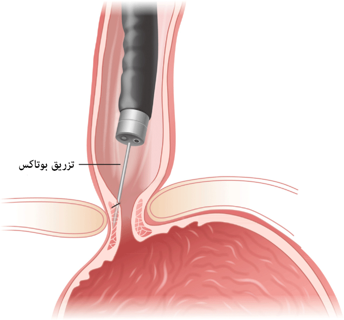 تزریق سم بوتولینوم (بوتاکس)