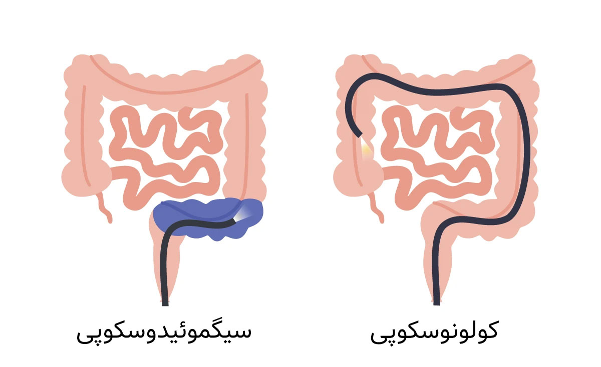 تشخیص هموروئید