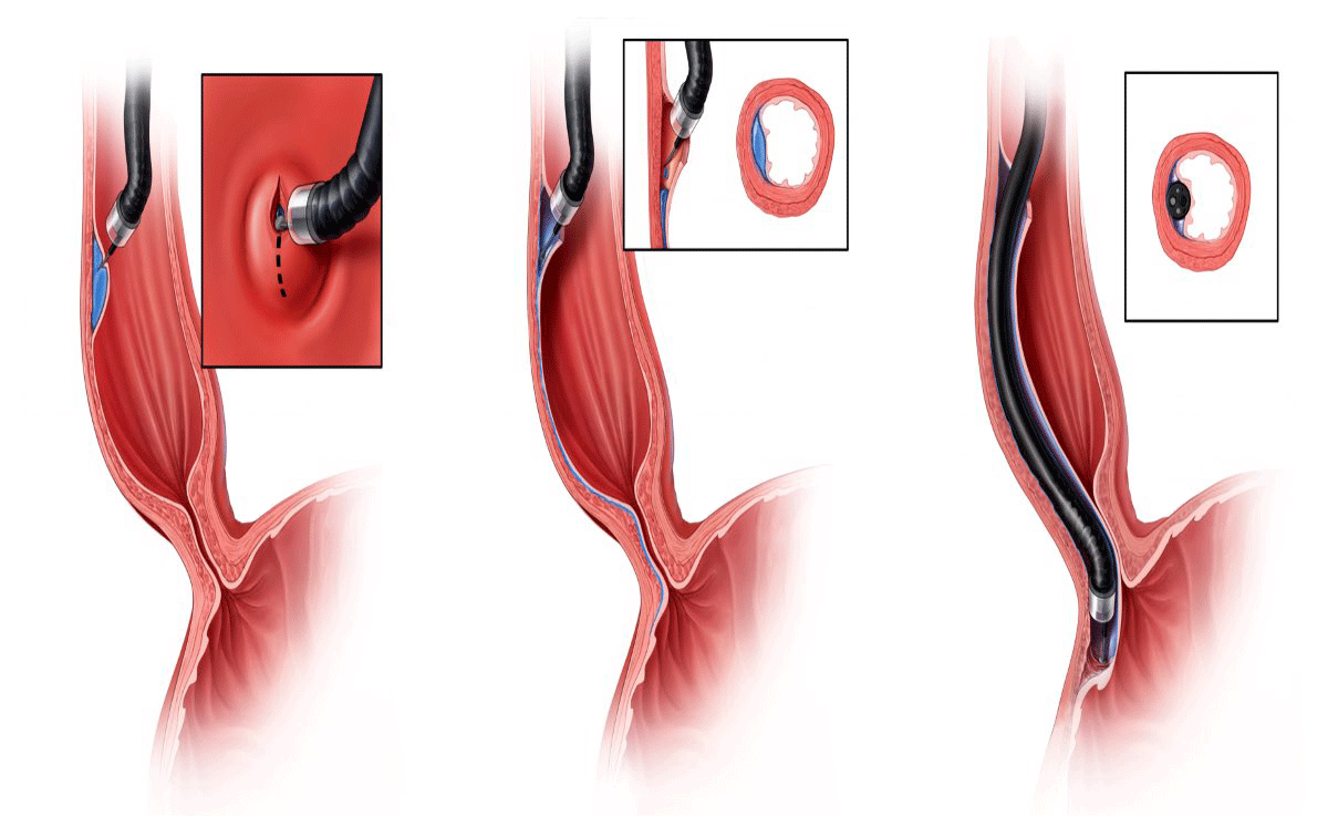 جراحی آشالازی — میوتومی مری