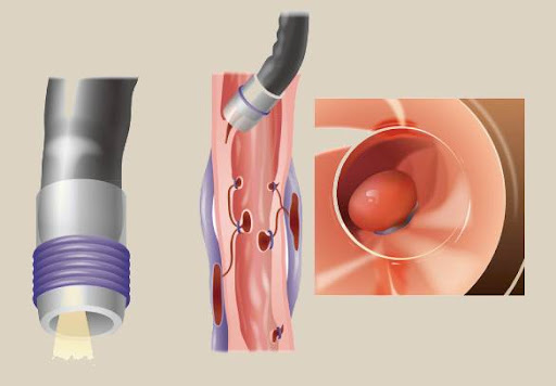 باندلیگاسیون واریس مری