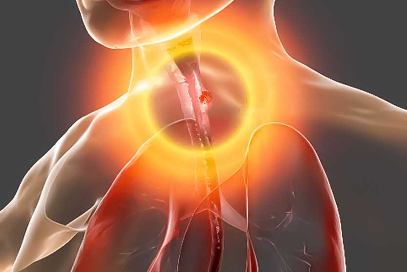 سرطان مری یا ازوفاگوس