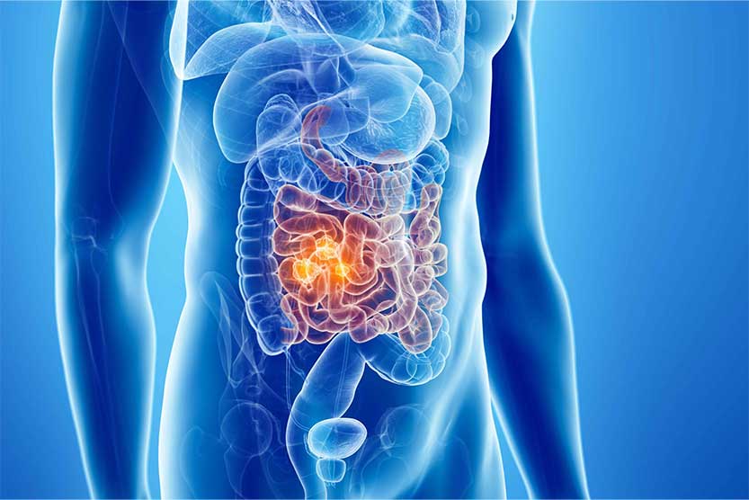 سرطان روده کوچک