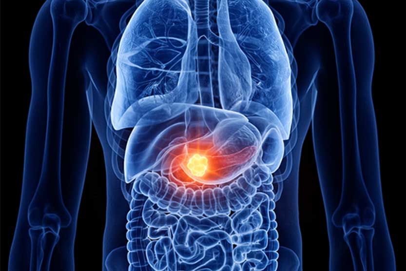 سرطان-پانکراس