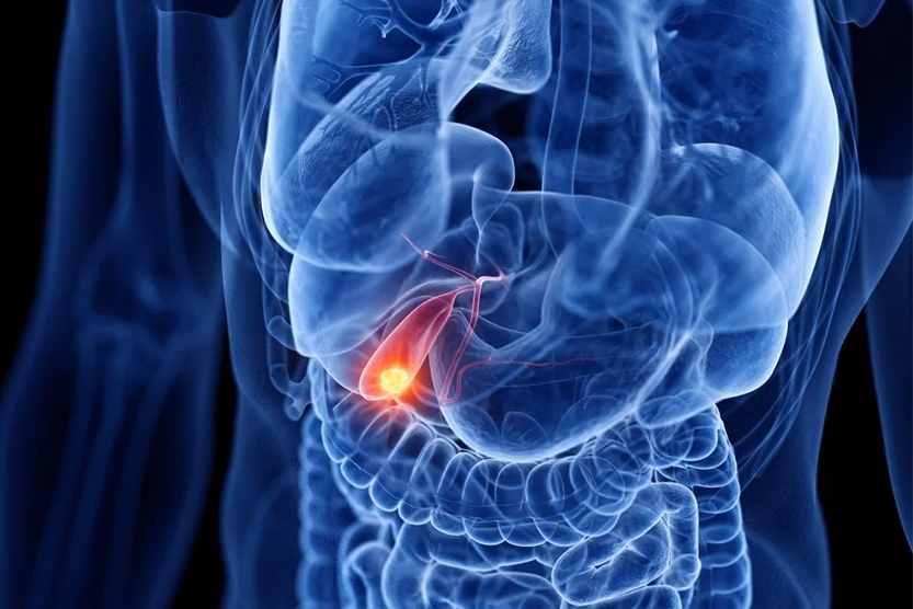 سرطان مجاری صفراوی