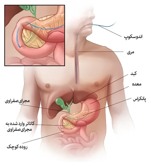 اندوسکوپی رتروگراد کلانژیوپانکراتوگرافی (ERCP- ای آر سی پی)